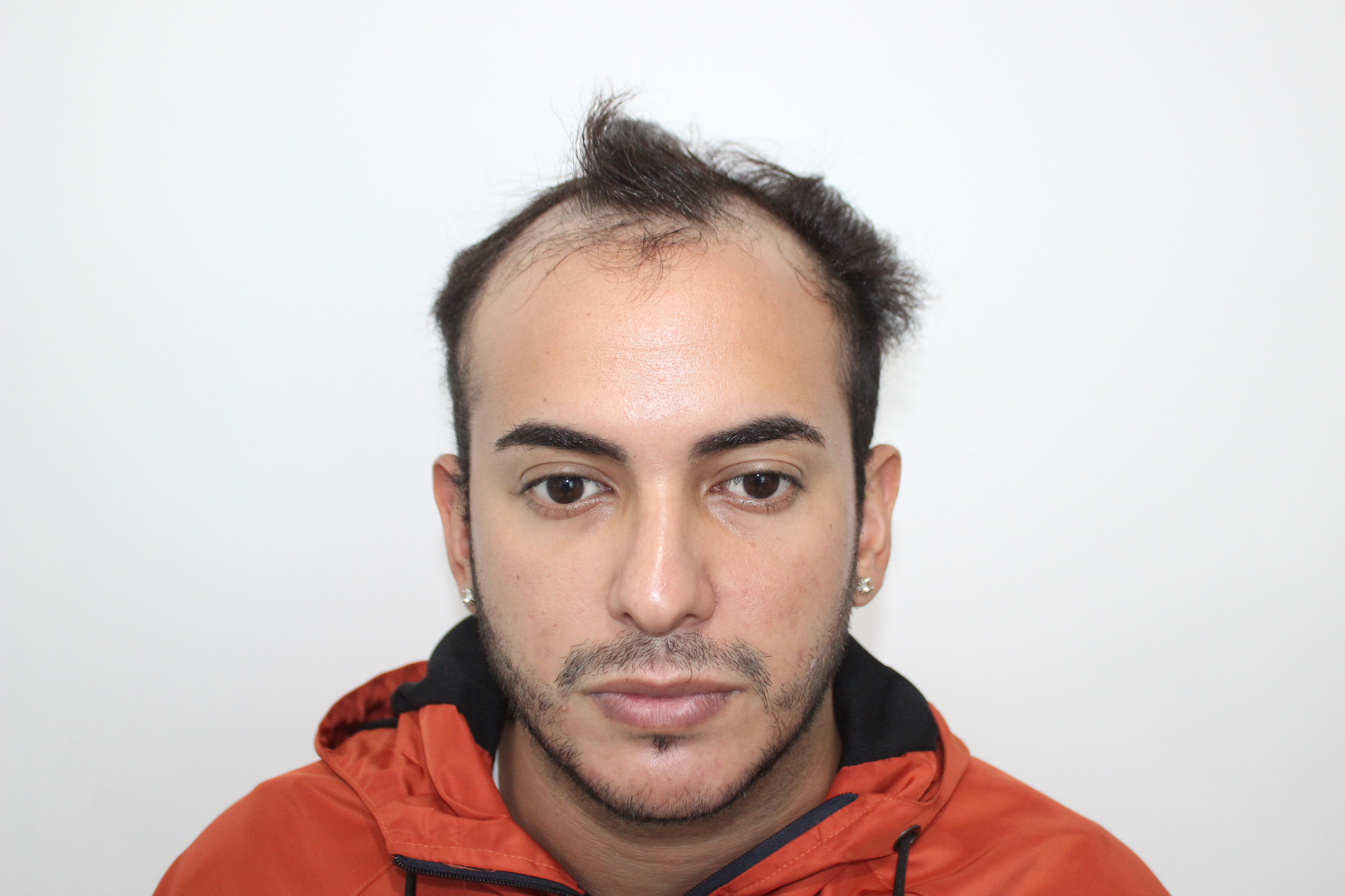 Antes del tratamiento - Caso 5