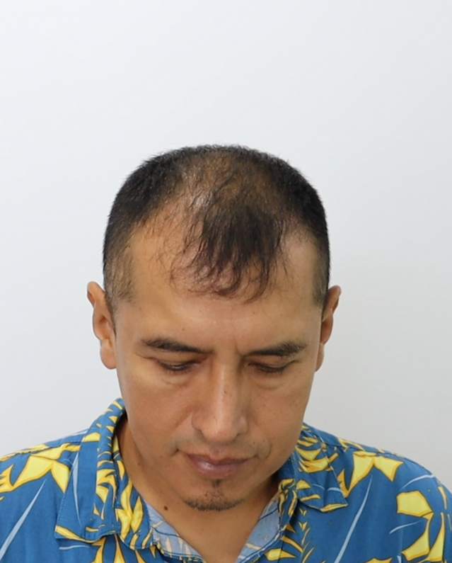 Antes del tratamiento - Caso 2